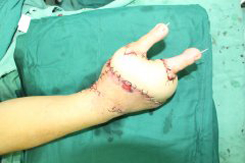 脚趾“变”手指，成功“移花接木”