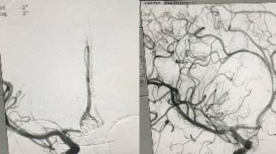 武冈展辉医院成功开展一例前交通动脉瘤介入栓塞术
